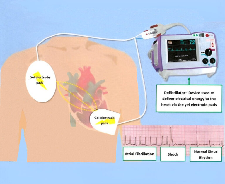 Transoesophageal Echocardiogram (TOE) | Pensinsula Cardiology