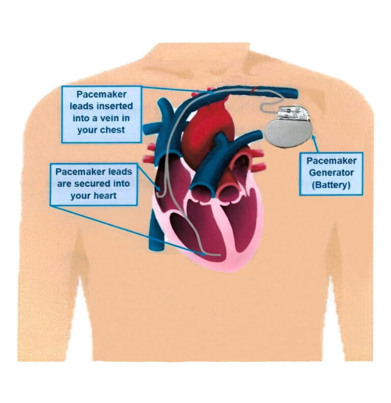 Pacemaker (PPM) Implantation | Pensinsula Cardiology Group