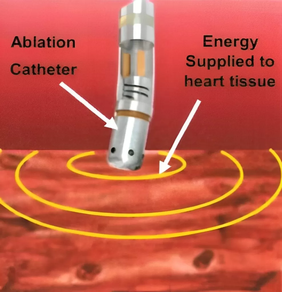 Pulmonary Vein Isolation | Pensinsula Cardiology Group